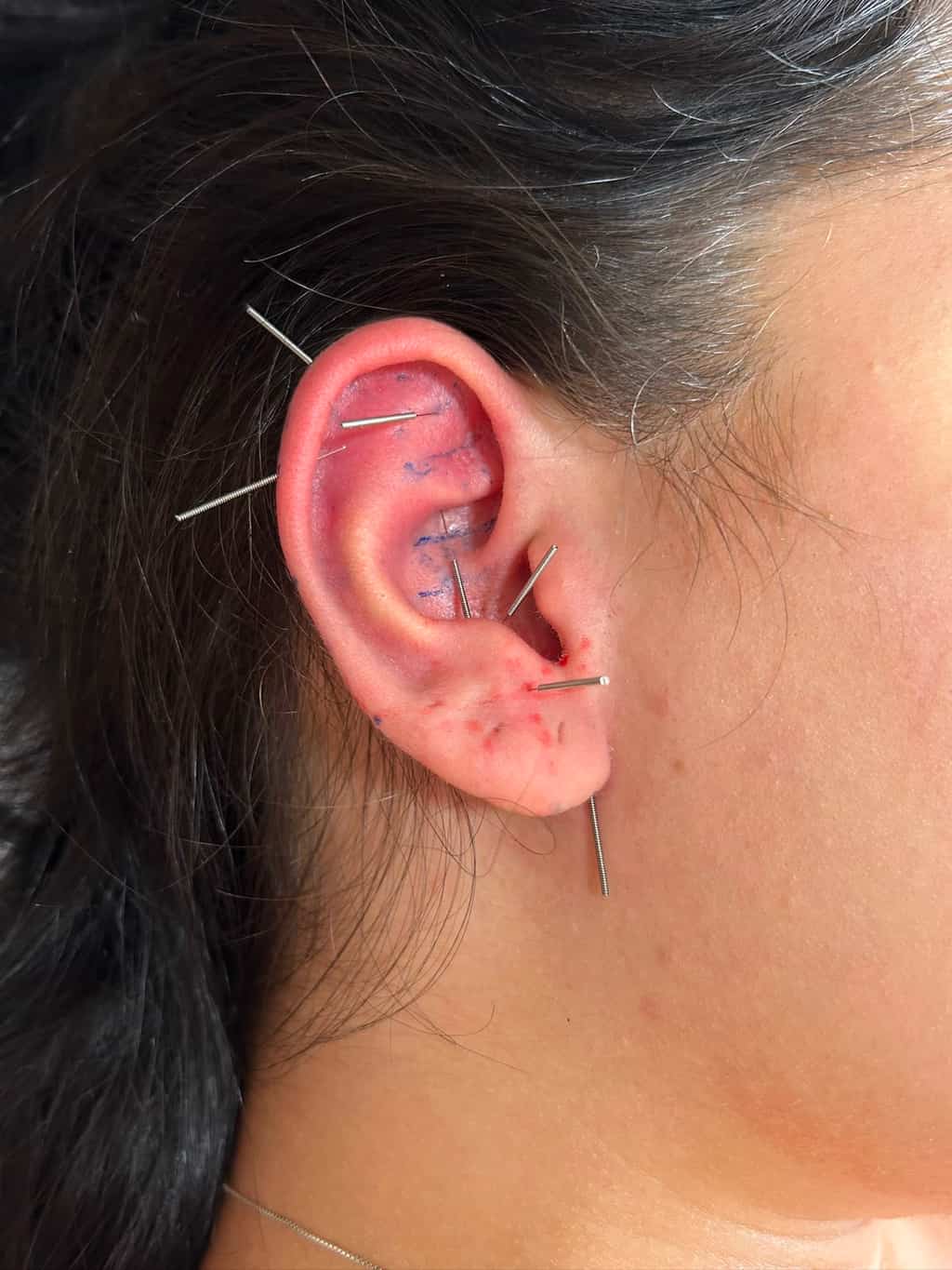 Sessão de auriculoterapia