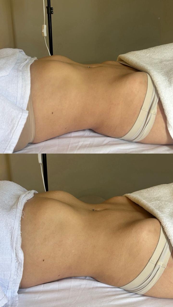 Resultado de drenagem linfática, antes e depois da sessão
