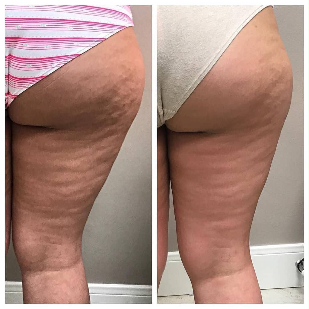 Antes e depois de drenagem para lipedema