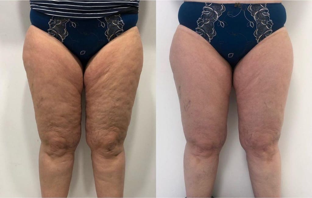 Antes e depois de drenagem para lipedema